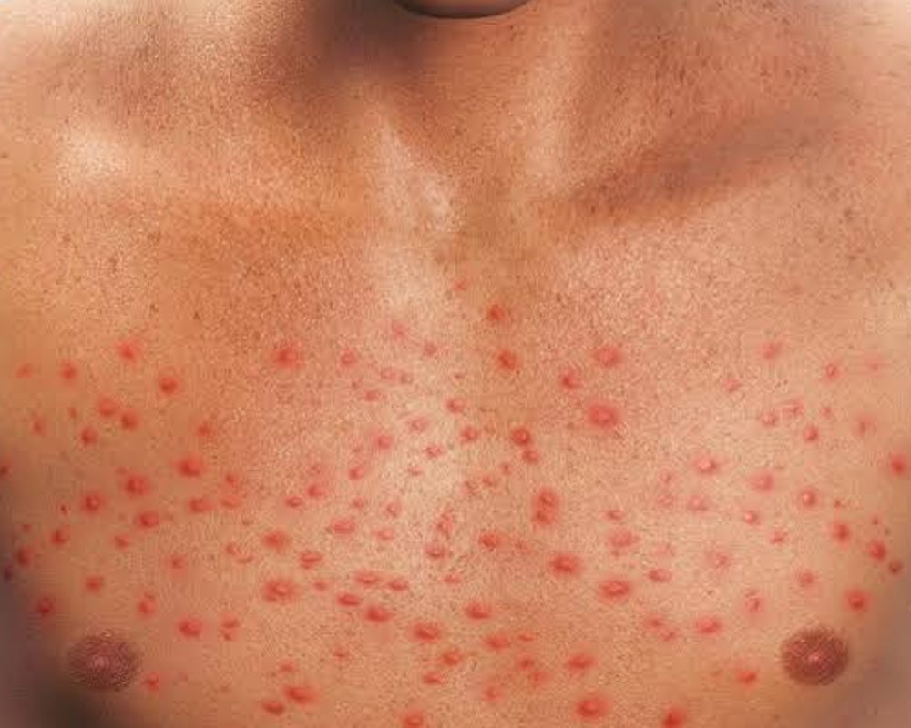 Cirrhosis Rash: Is Your Rash Caused By Hepatitis?