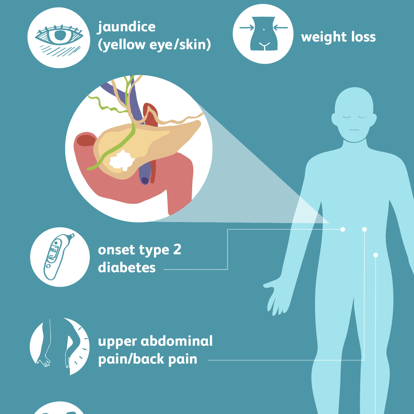 Pancreatic Cancer: Signs, Symptoms, and Complications