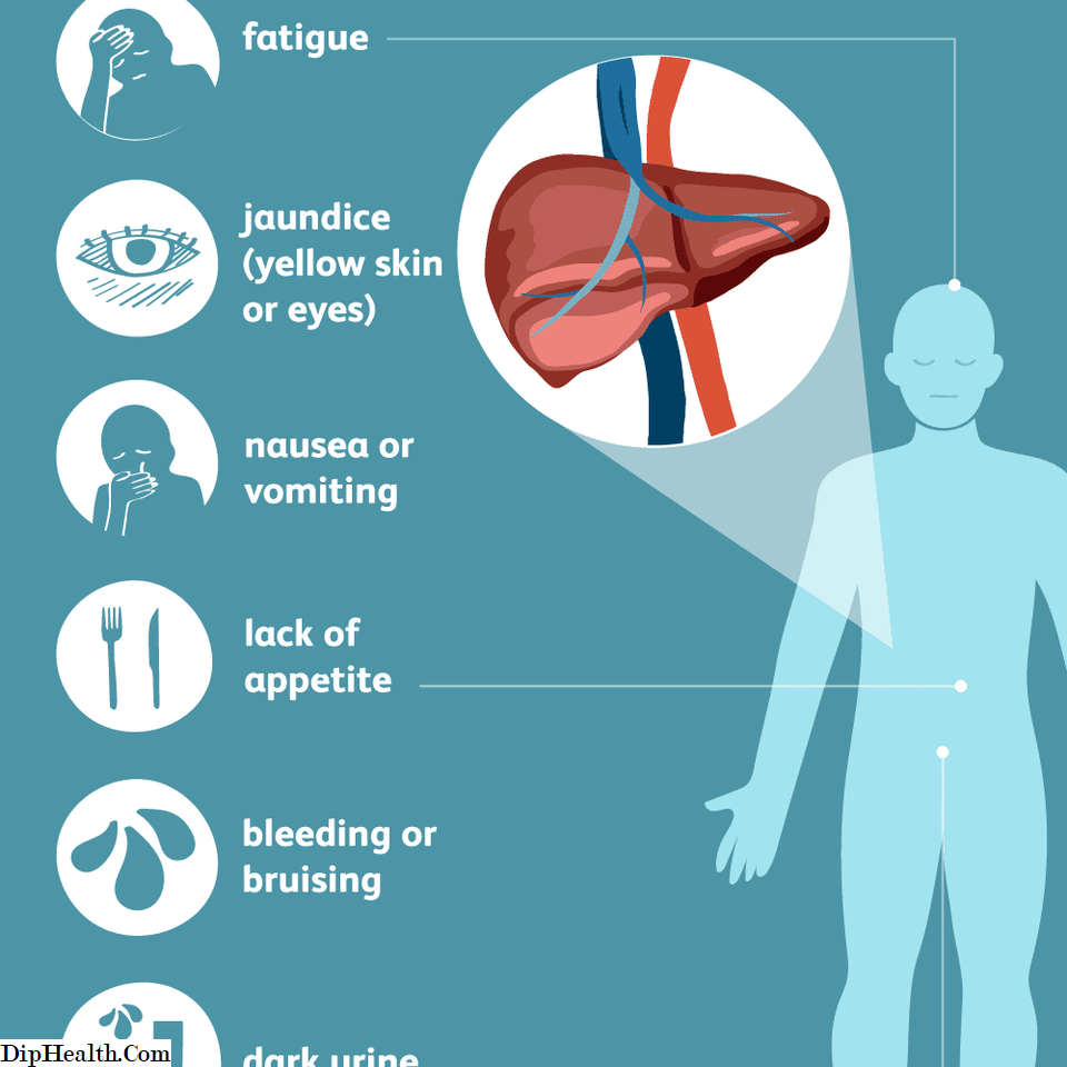 Virus de la hepatitis C: signos, síntomas y complicaciones